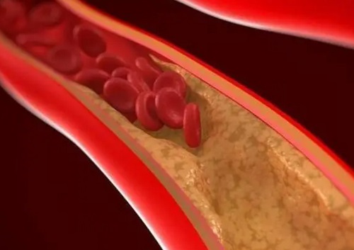 血管发出的求救信号有哪些 造成血管堵塞的原因是什么